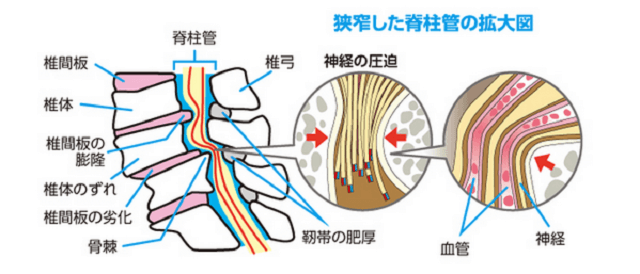 狭窄症